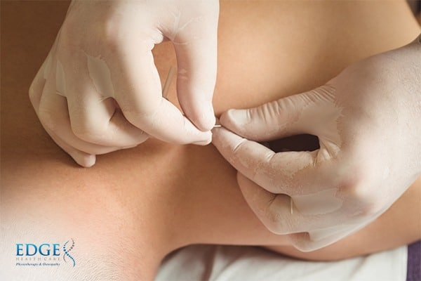 Scottsdale Electro Dry Needling by a Physical Therapist & Pricing